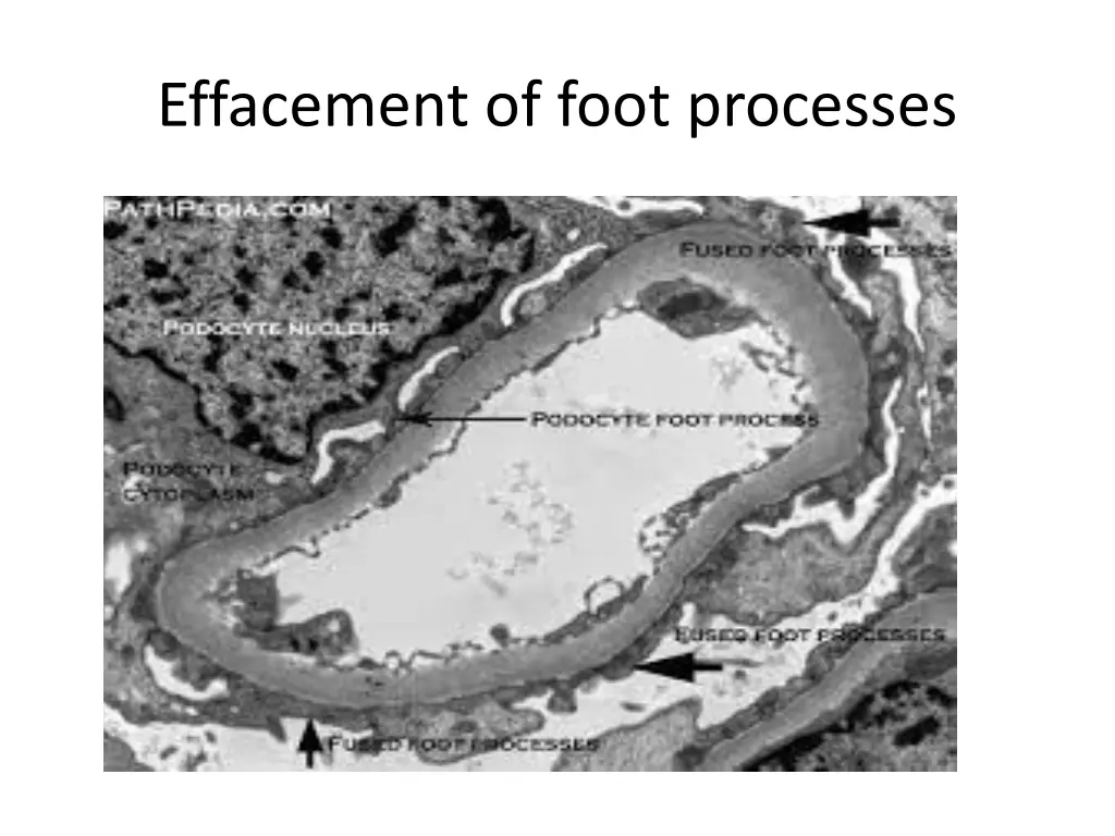 effacement of foot processes