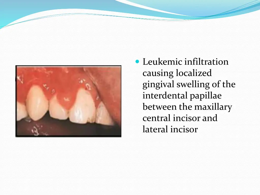 leukemic infiltration causing localized gingival