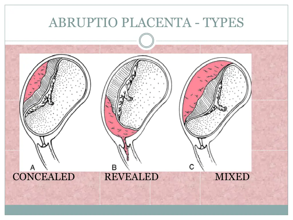 abruptio placenta types