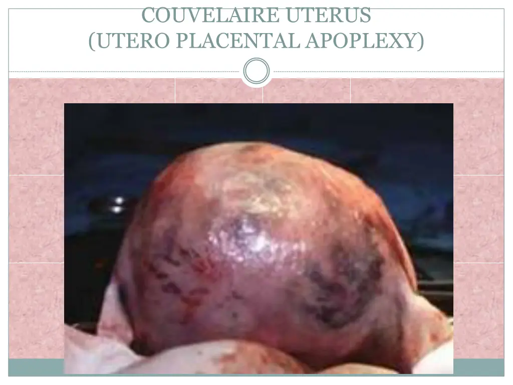 couvelaire uterus utero placental apoplexy