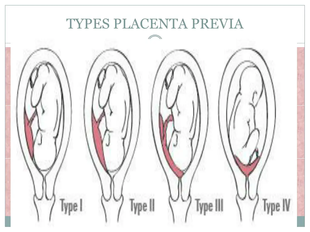 types placenta previa