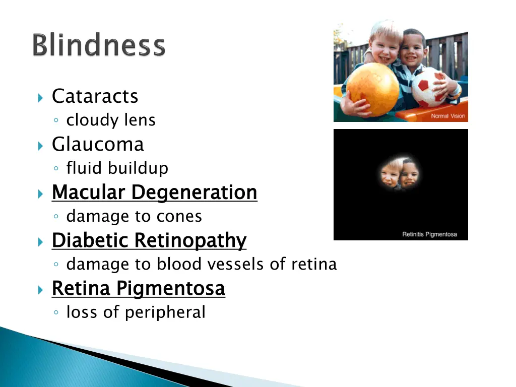 cataracts cloudy lens glaucoma fluid buildup