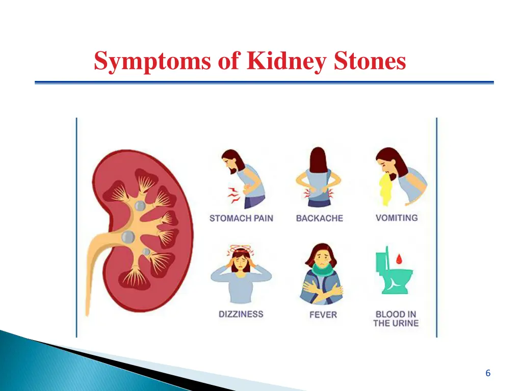 symptoms of kidney stones