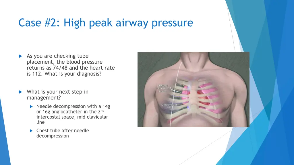 case 2 high peak airway pressure 2