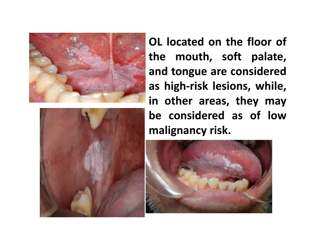 ol located on the floor of the mouth soft palate