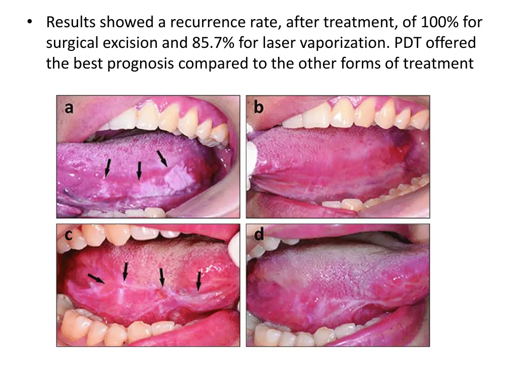 results showed a recurrence rate after treatment