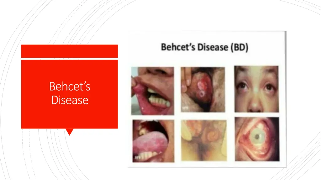 behcet s disease