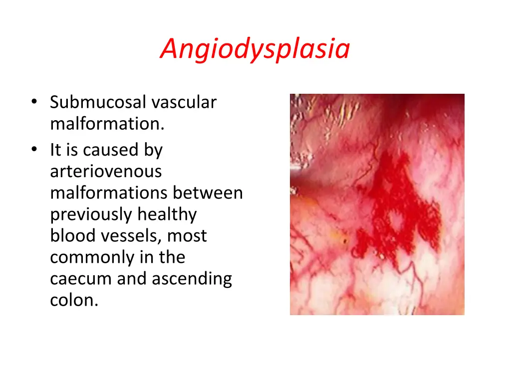 angiodysplasia