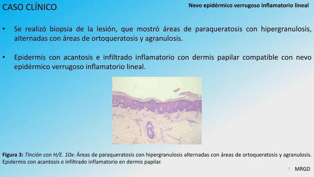 nevo epid rmico verrugoso inflamatorio lineal 4
