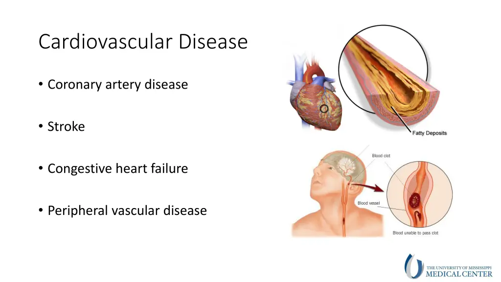 cardiovascular disease