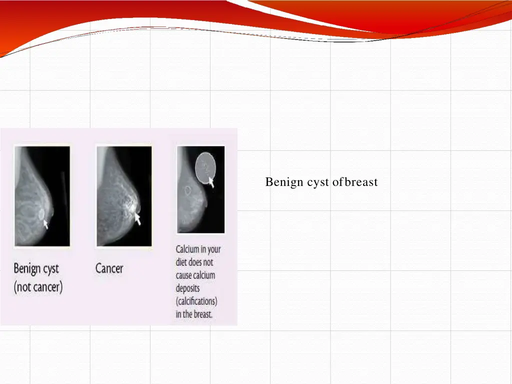 benign cyst of breast