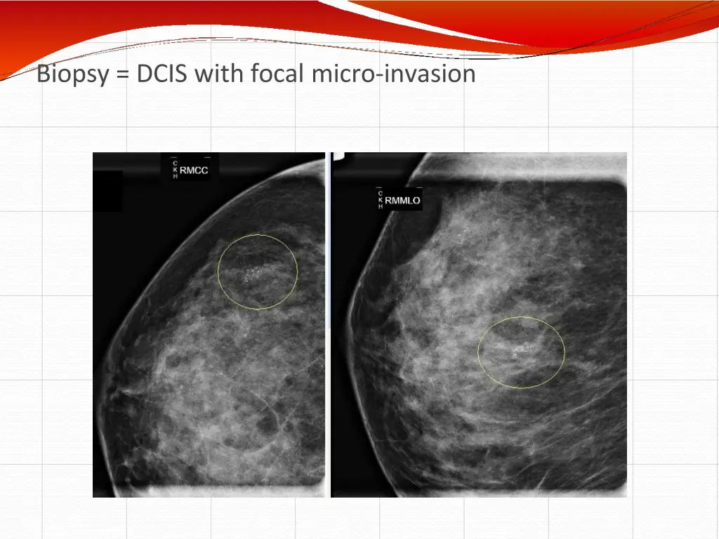 biopsy dcis with focal micro invasion