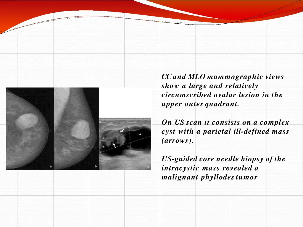 cc and mlo mammographic views show a large