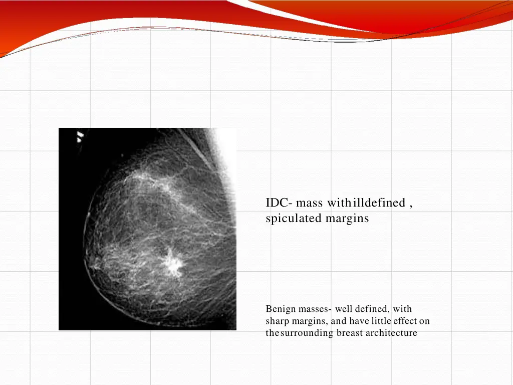 idc mass with illdefined spiculated margins