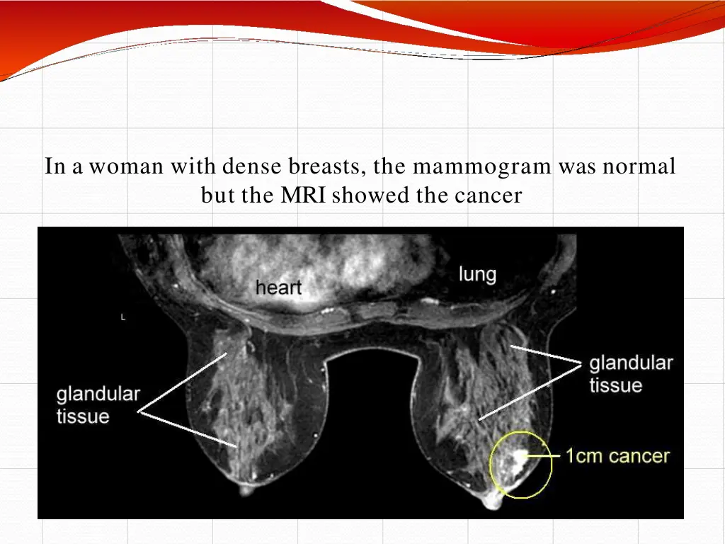 in a woman with dense breasts the mammogram