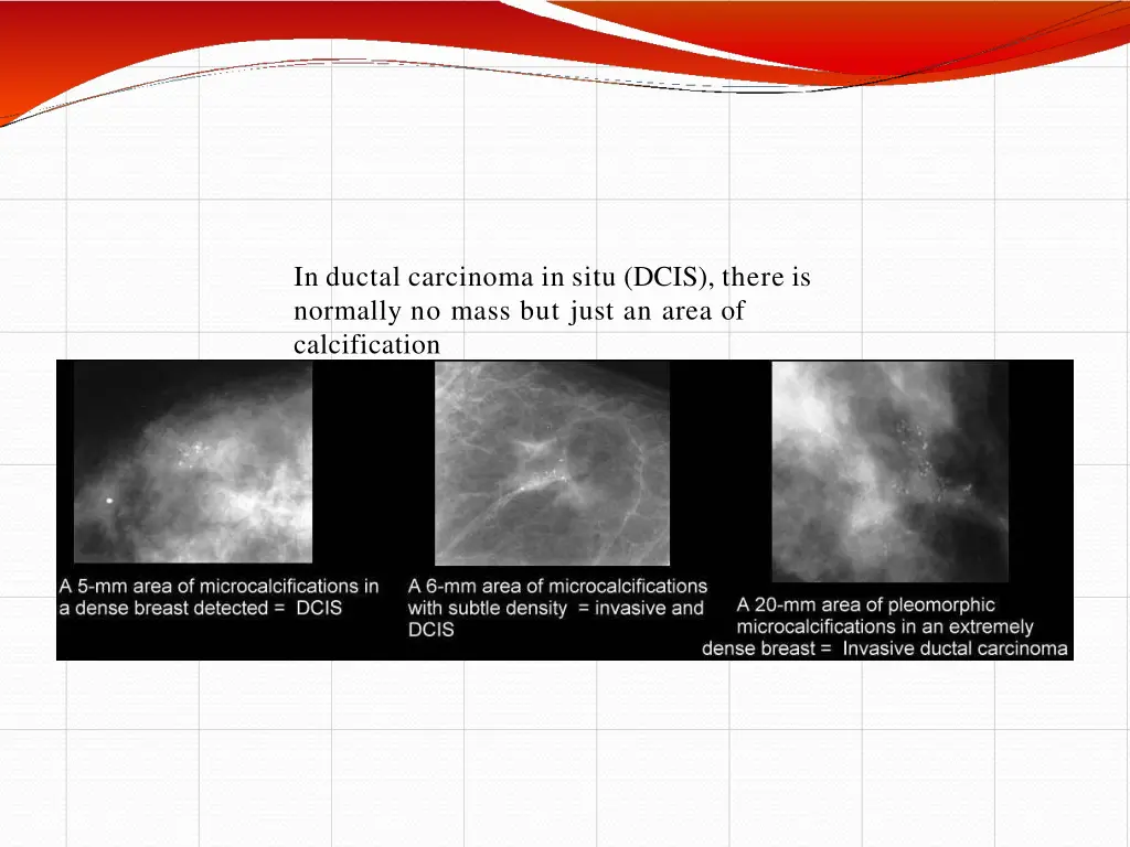 in ductal carcinoma in situ dcis there