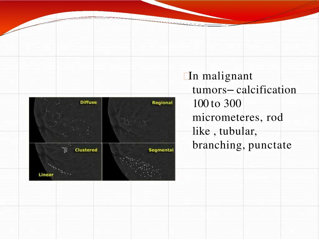 in malignant tumors calcification