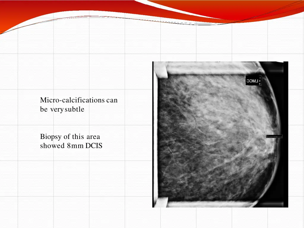 micro calcifications can be very subtle