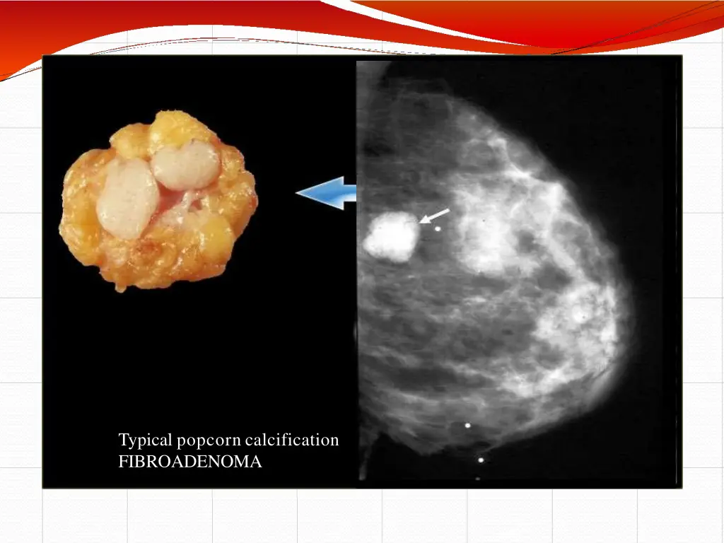 typical popcorn calcification fibroadenoma