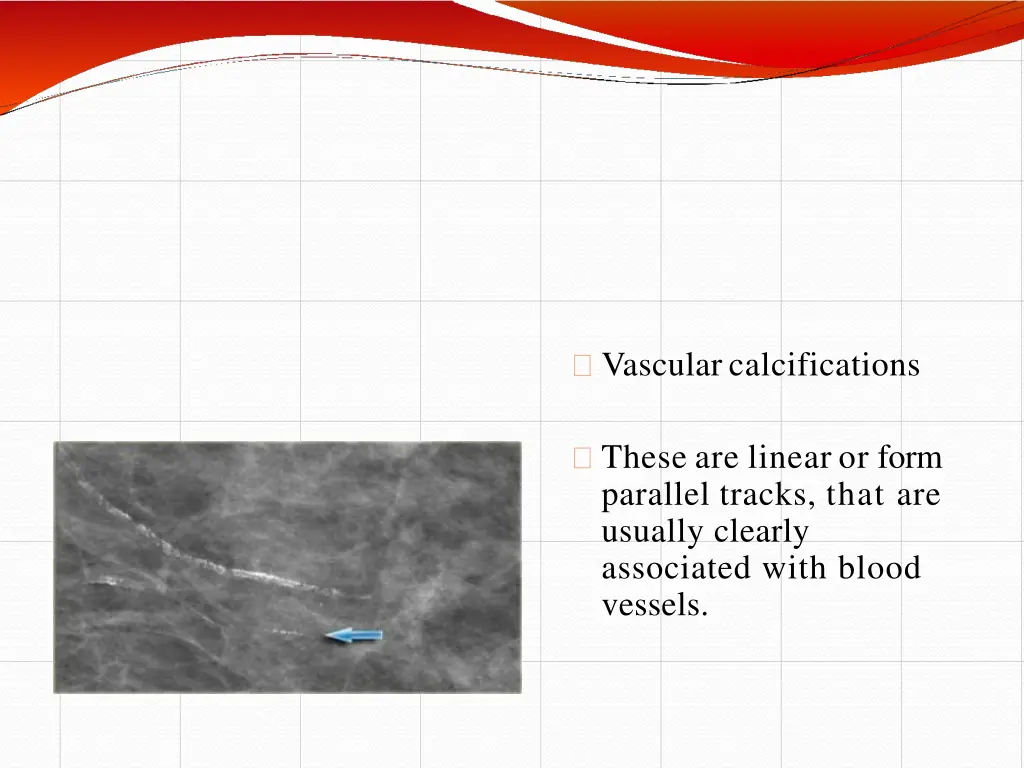 vascular calcifications