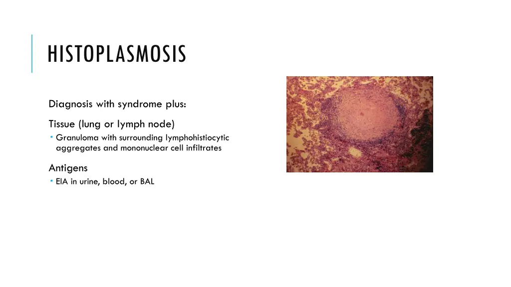 histoplasmosis 2