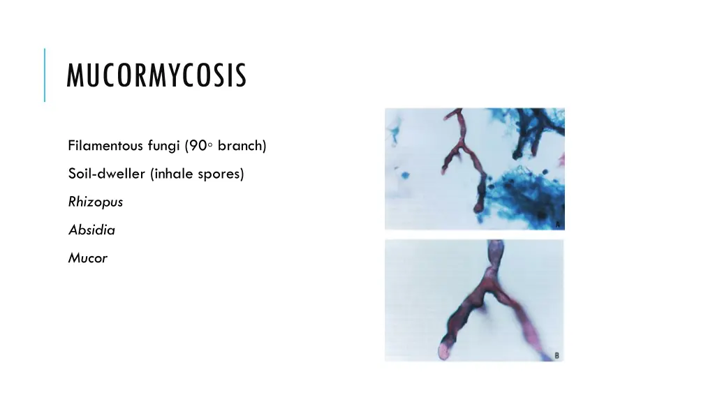 mucormycosis