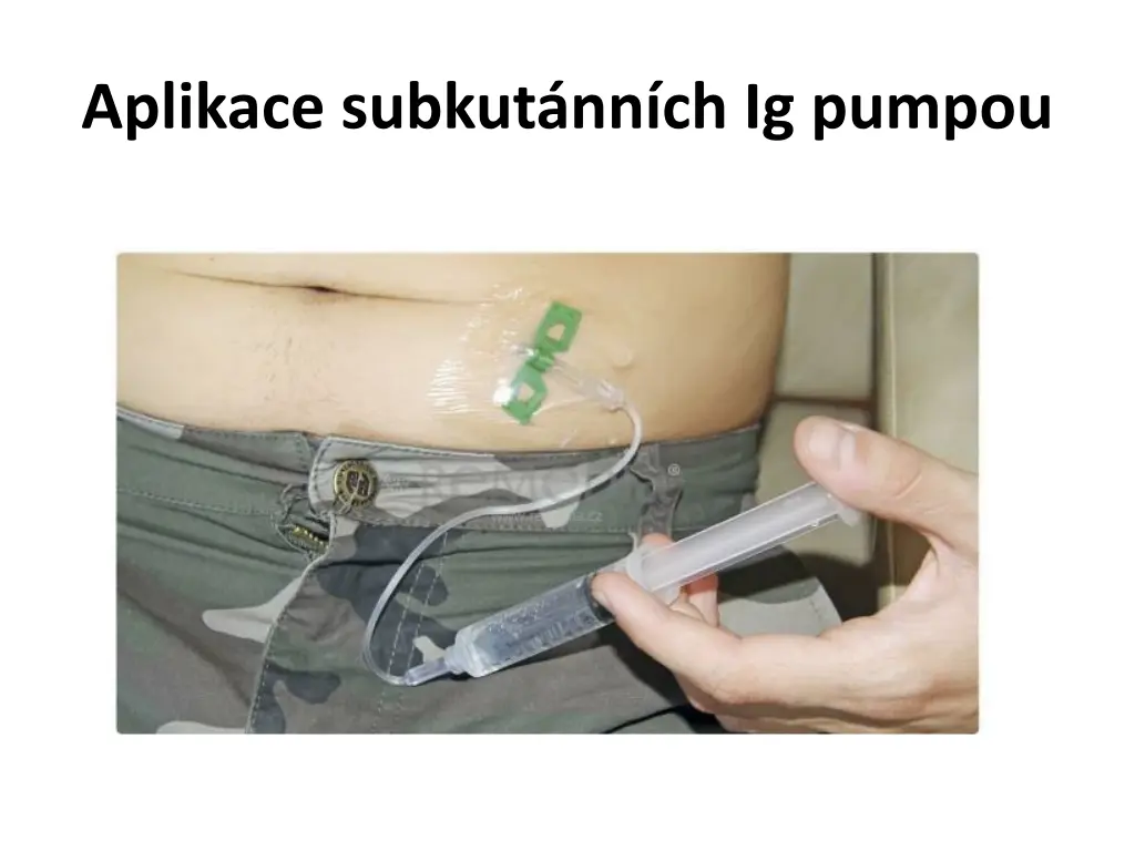 aplikace subkut nn ch ig pumpou