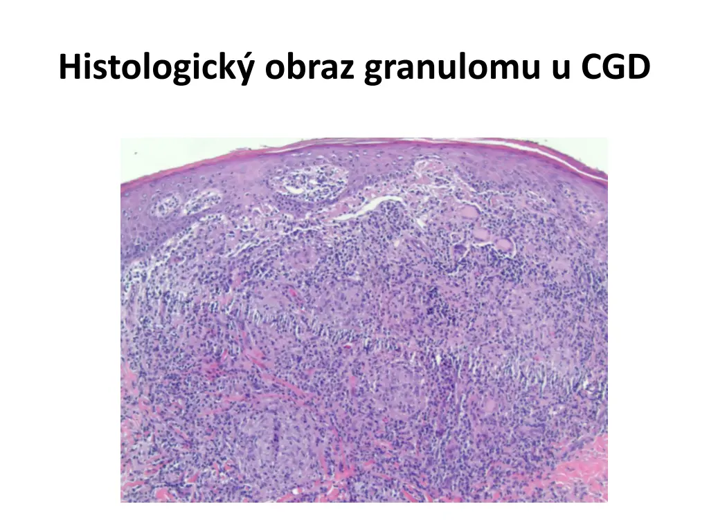histologick obraz granulomu u cgd