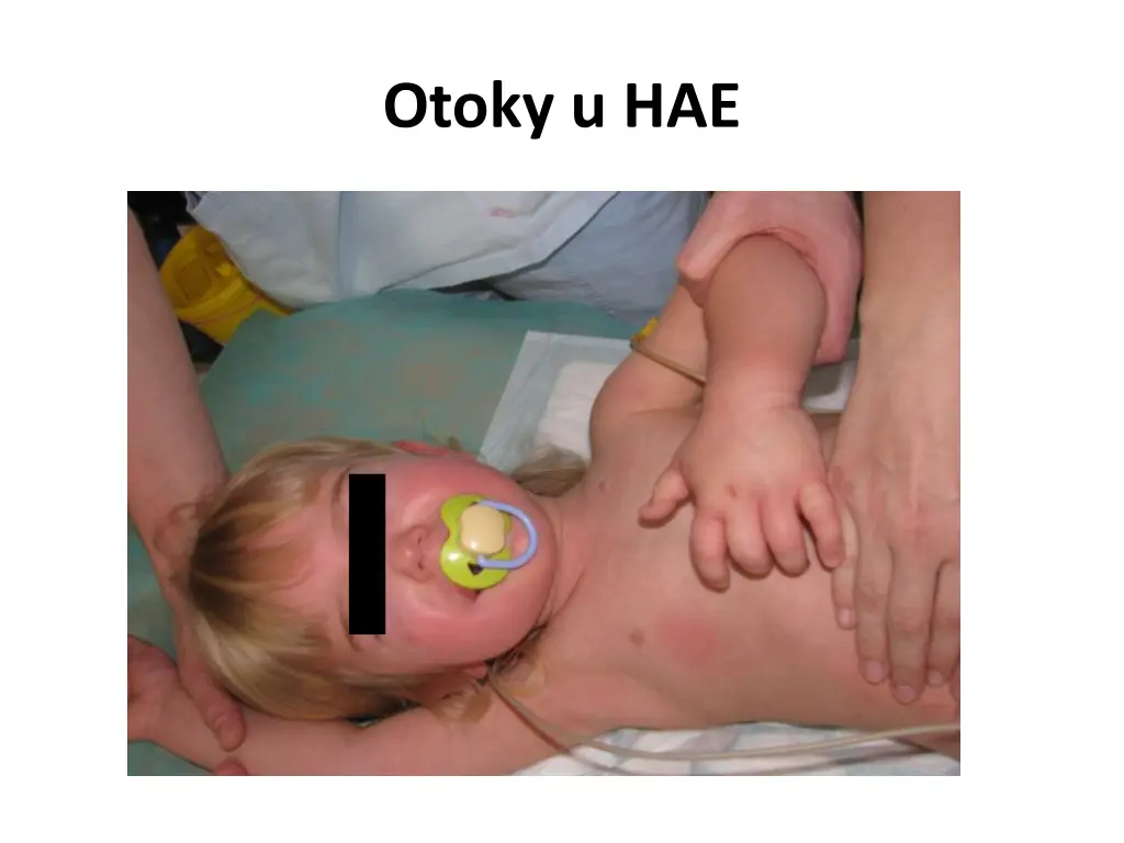 otoky u hae