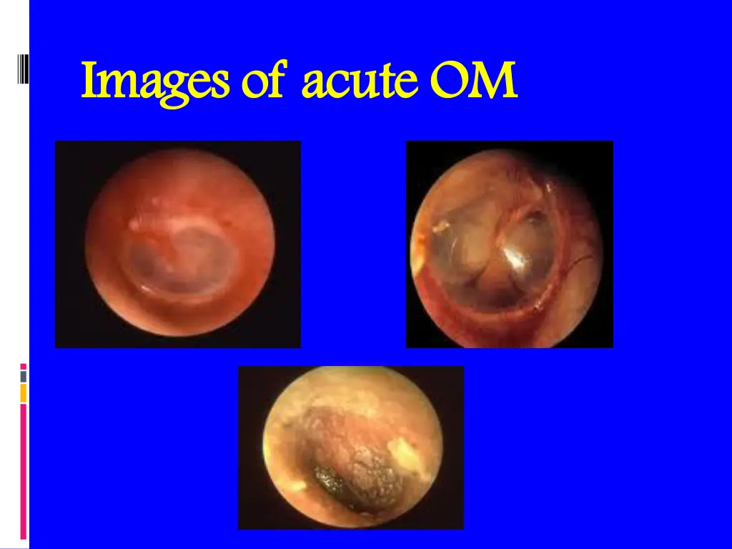images of acute om images of acute om