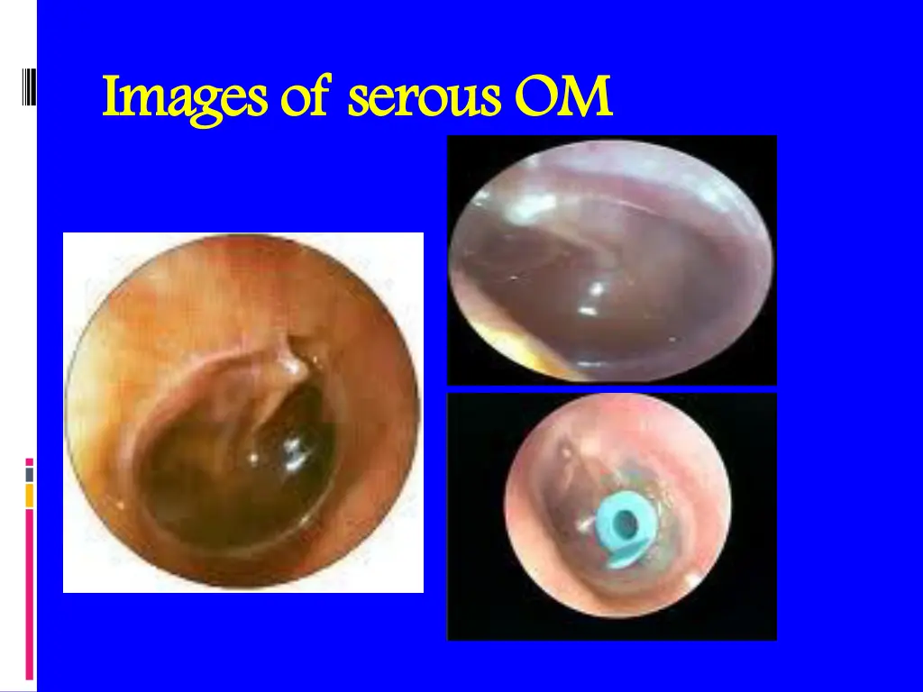 images of serous om images of serous om