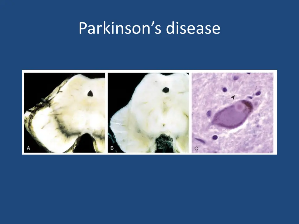 parkinson s disease 5
