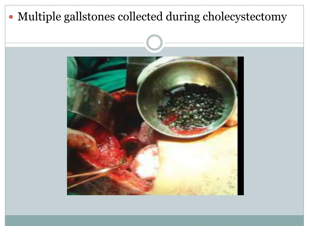 multiple gallstones collected during