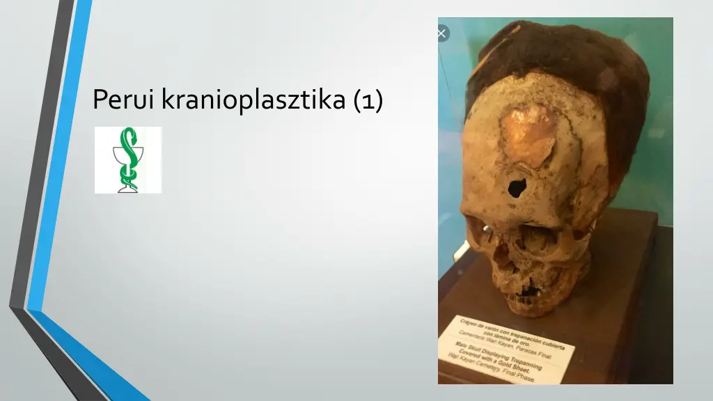 perui kranioplasztika 1