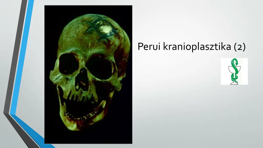 perui kranioplasztika 2