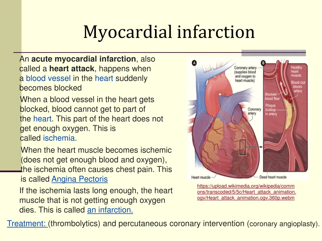 myocardial infarction