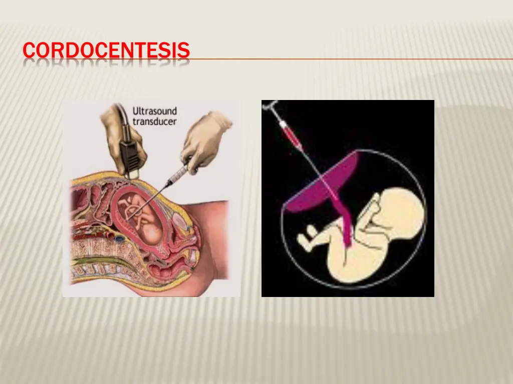 cordocentesis