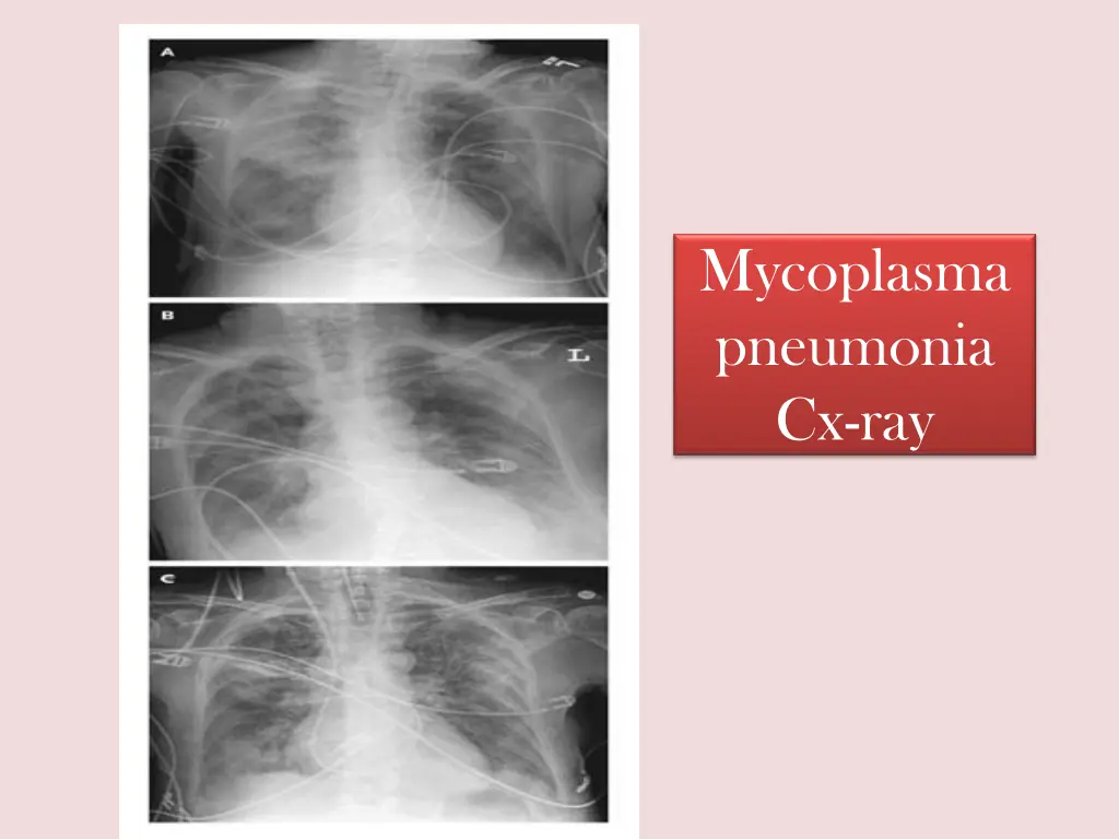 mycoplasma pneumonia cx ray