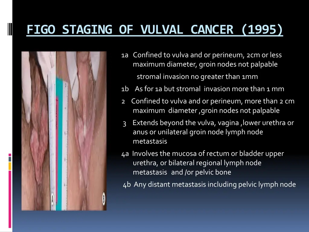 figo staging of vulval cancer 1995