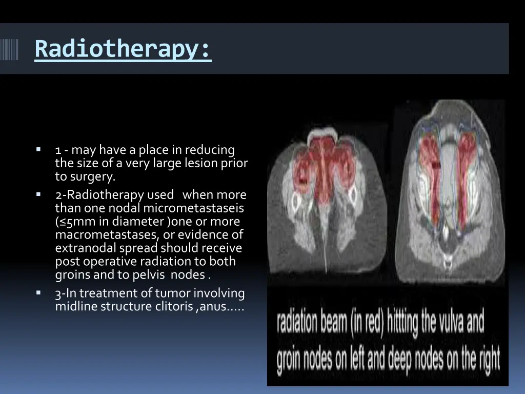 radiotherapy