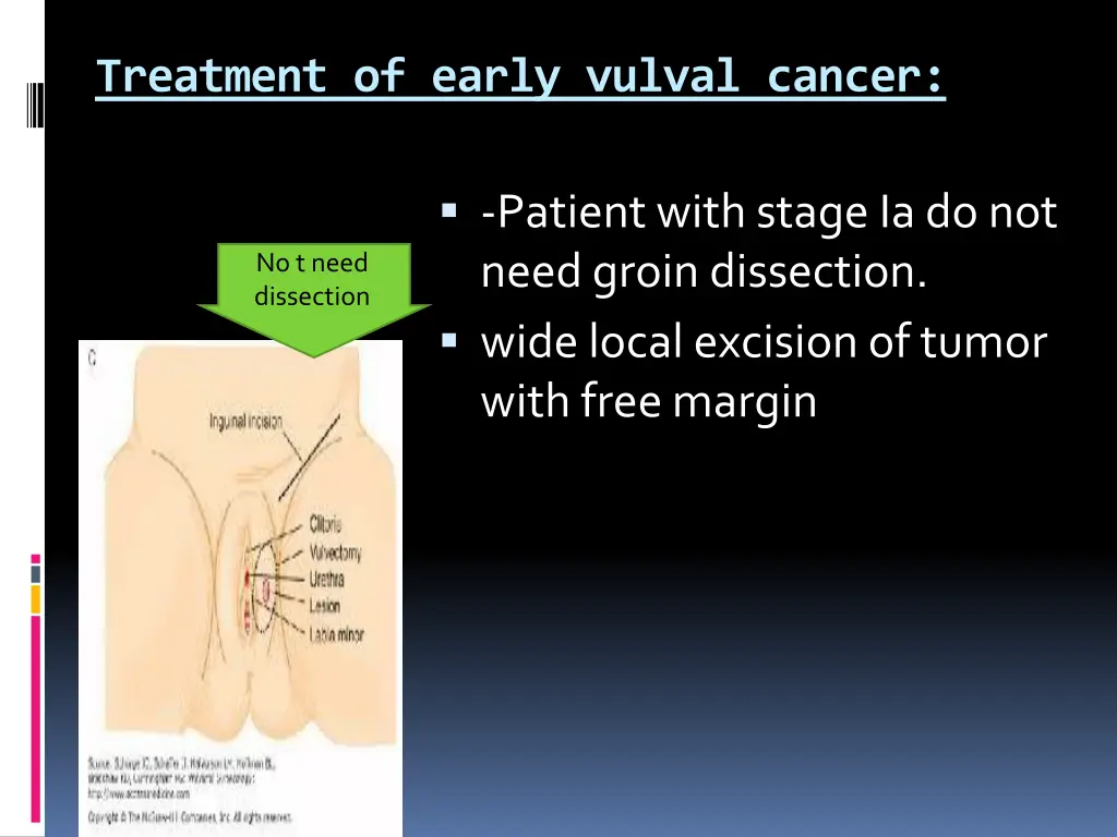 treatment of early vulval cancer