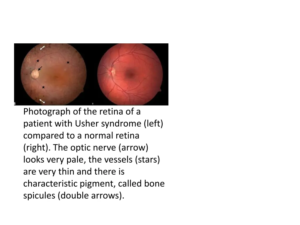 photograph of the retina of a patient with usher