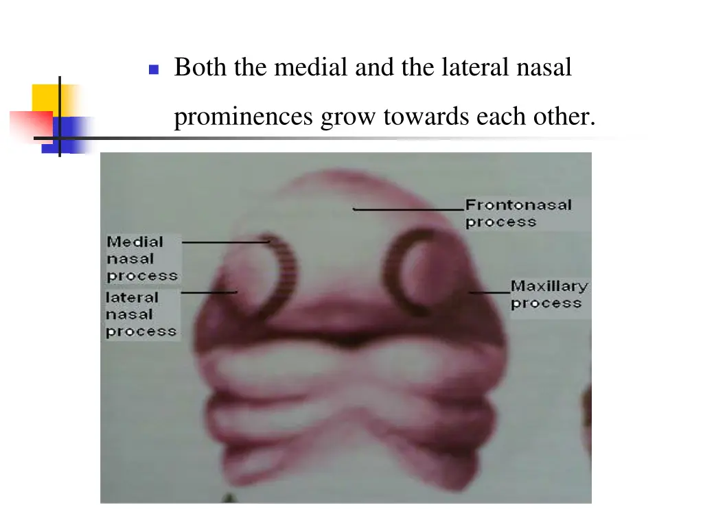 both the medial and the lateral nasal
