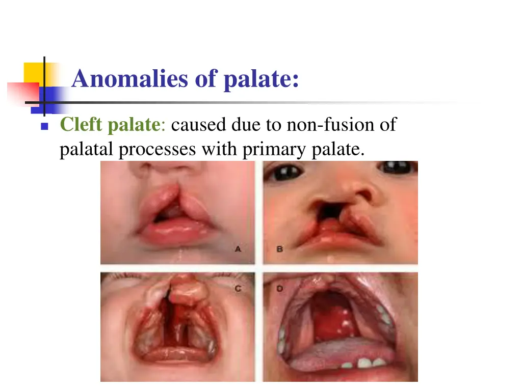 anomalies of palate