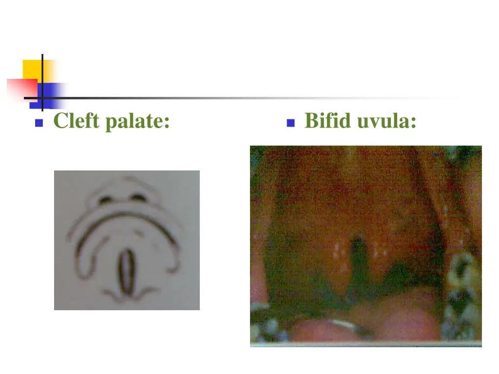 cleft palate