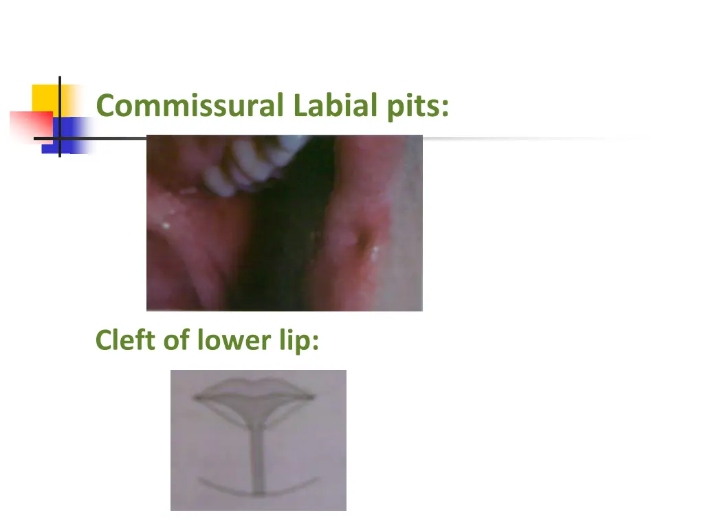 commissural labial pits