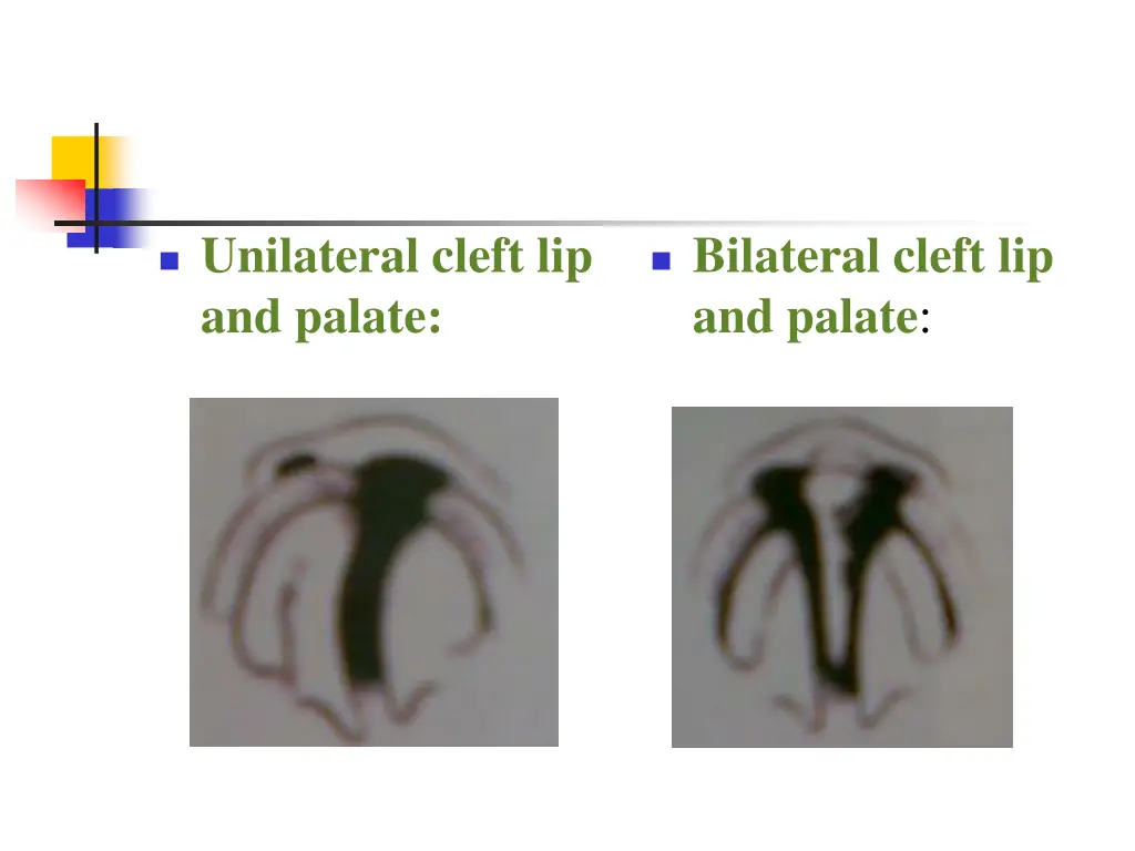 unilateral cleft lip and palate