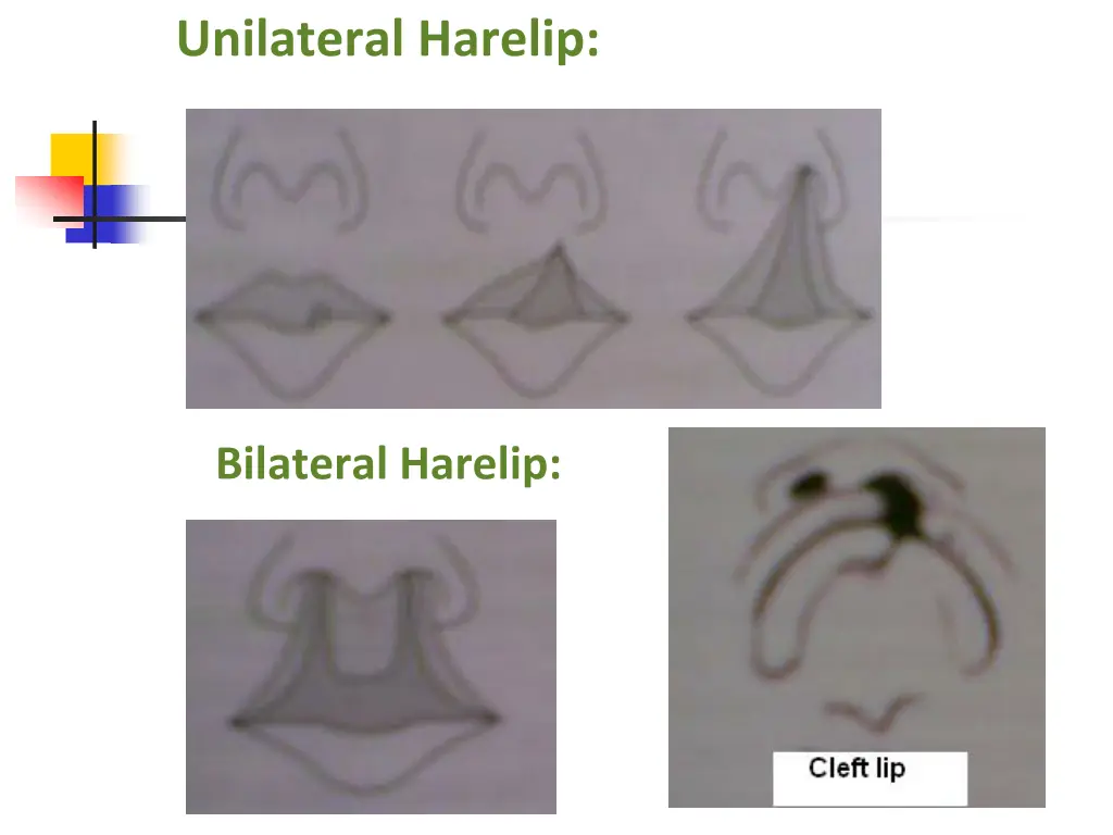 unilateral harelip