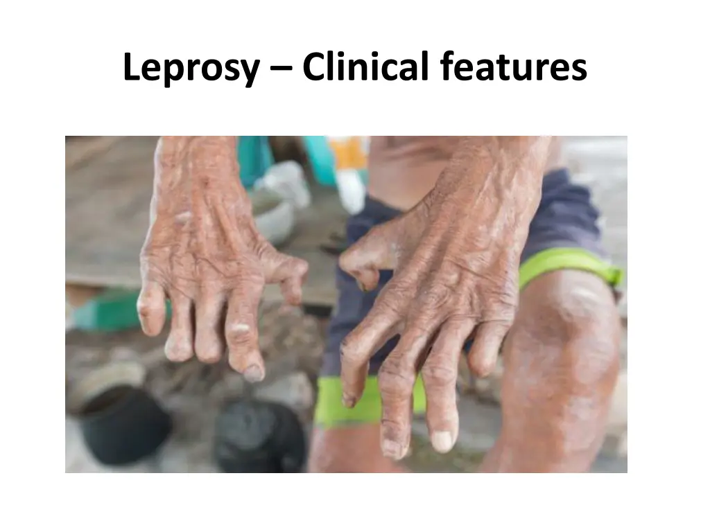 leprosy clinical features 1
