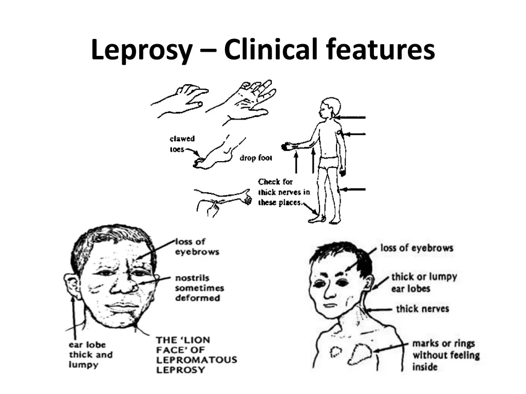 leprosy clinical features 2